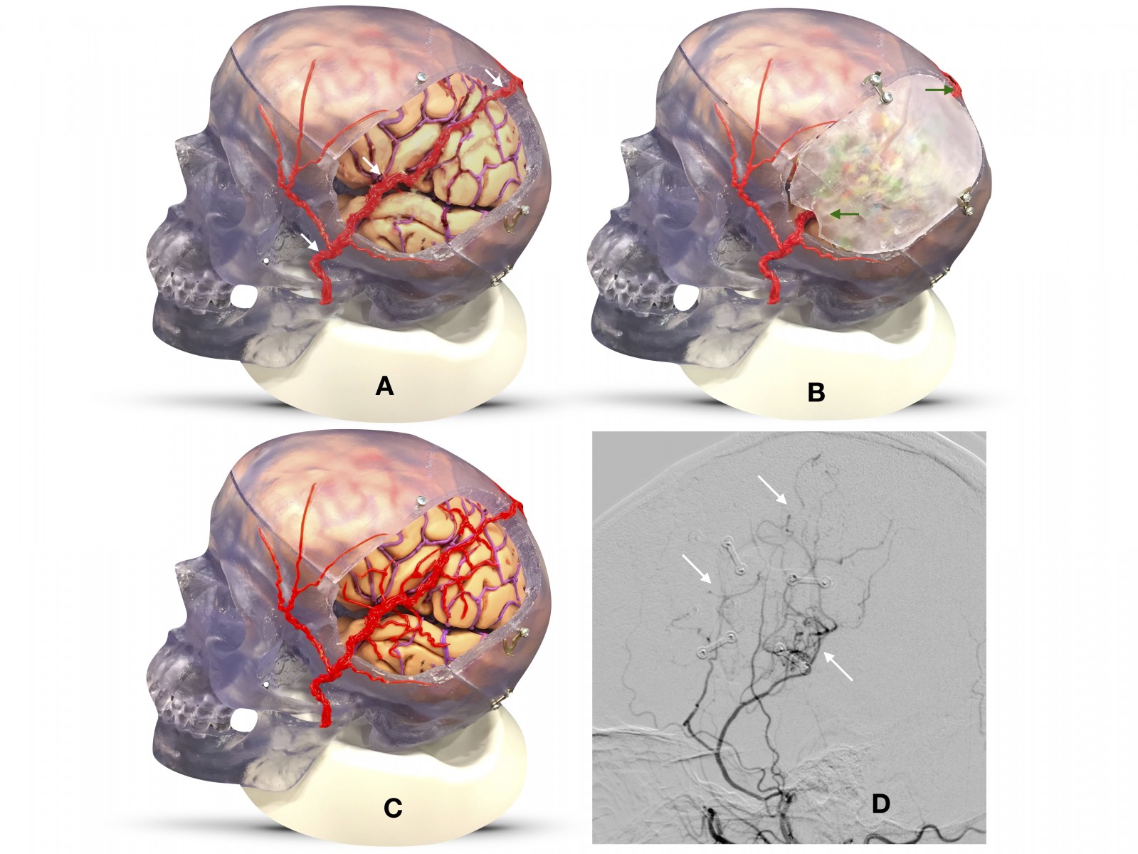 Surgery Technique Reduces Strokes in Atherosclerosis Patients