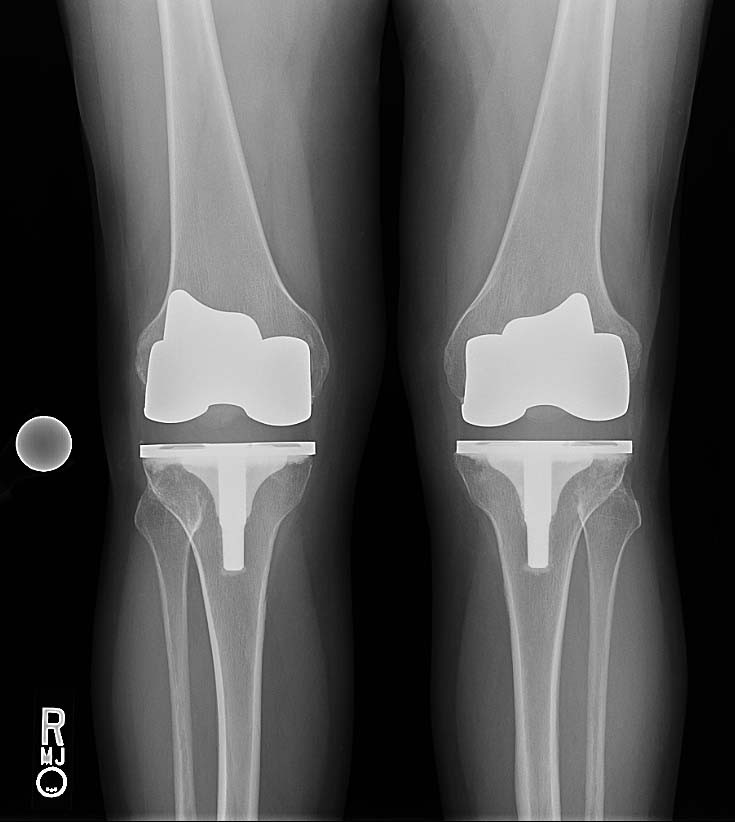 Disparities in Unilateral vs. Bilateral Knee Replacement