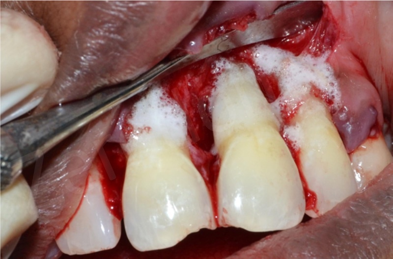 Treatment of intrabony defect using platelet rich fibrin