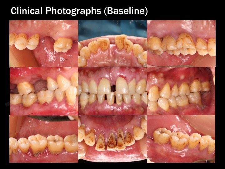 Severe generalized Chronic periodontitis Dr Judy Tse