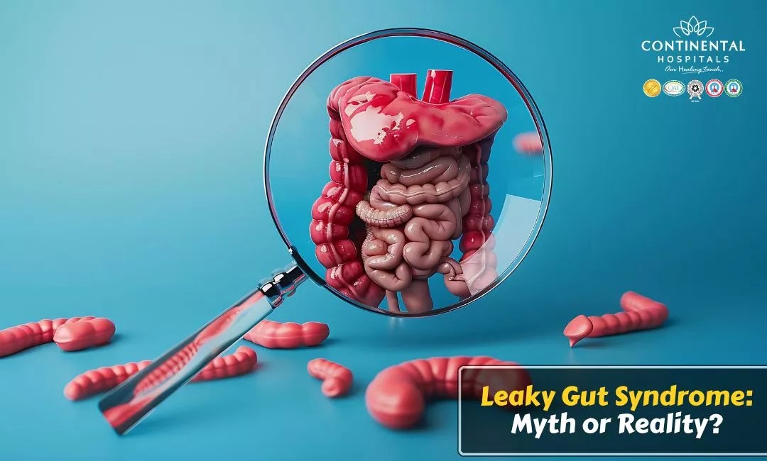 Leaky Gut Syndrome Myth or Reality?