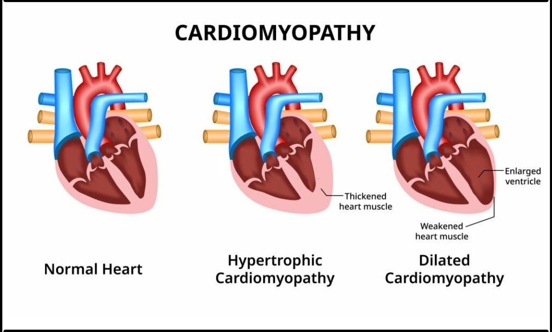 Cardiomyopathy Causes, Risk Factors, Symptoms, Treatment