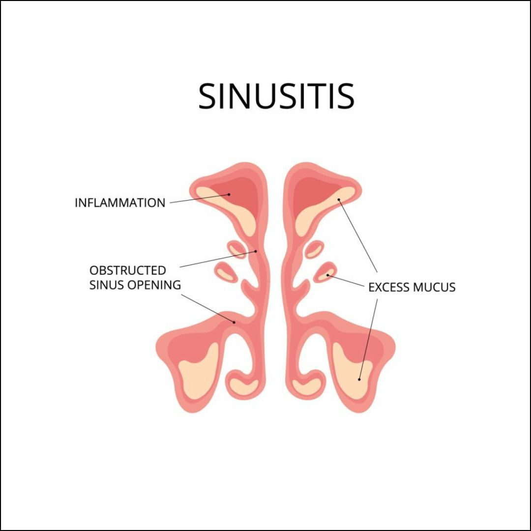 Home Remedies for Sinusitis Relief