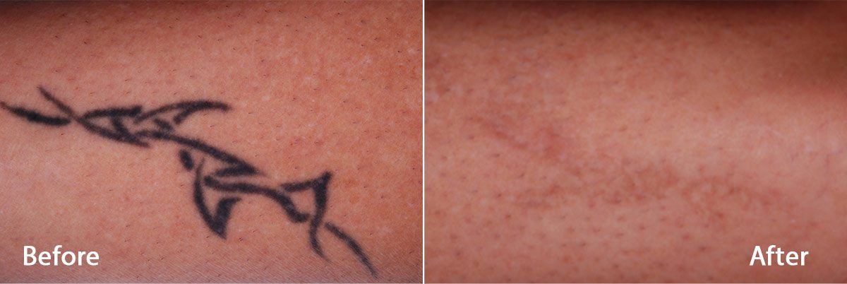 Picoway Laser | Tattoo Removal | All Colors No Problem 402_x_1200_jpg