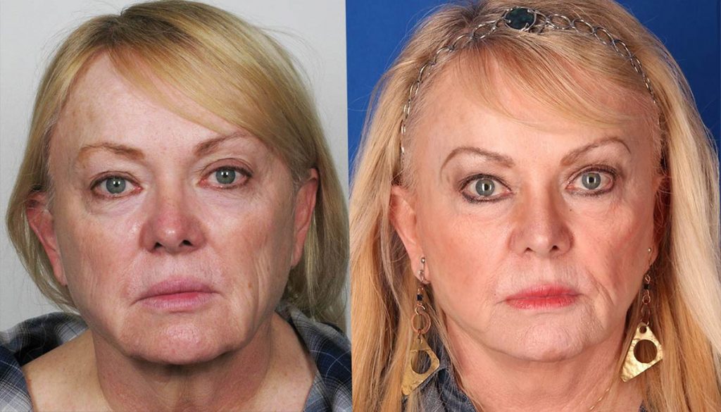Contour Dermatology Minifacelift before and after