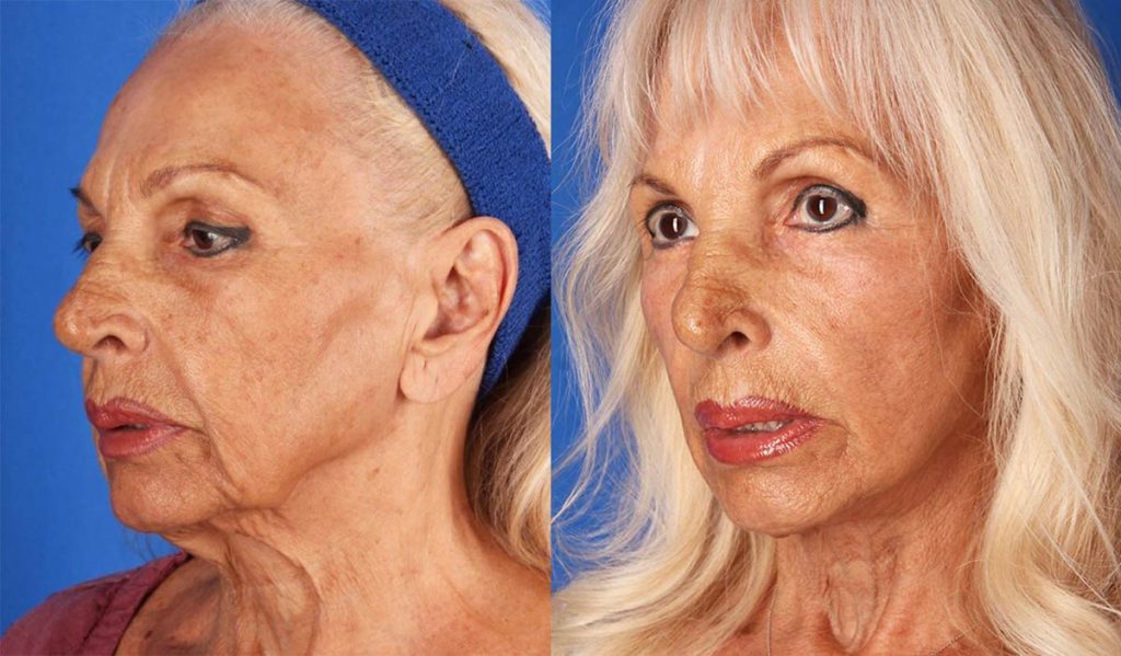 Contour Dermatology Mini Facelift by Dr Timothy Jochen Contour