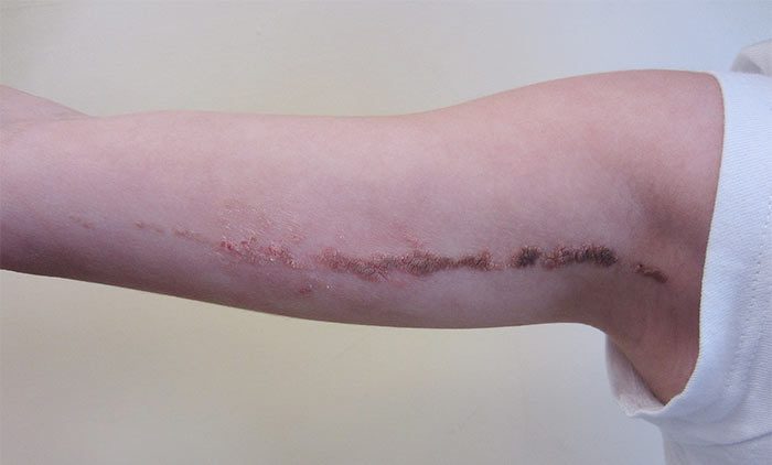 Contour Dermatology Epidermal Nevus Contour Dermatology