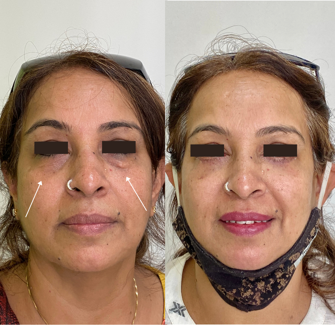 Xanthelasma Removal Excision Best Plastic & Cosmetic Surgery