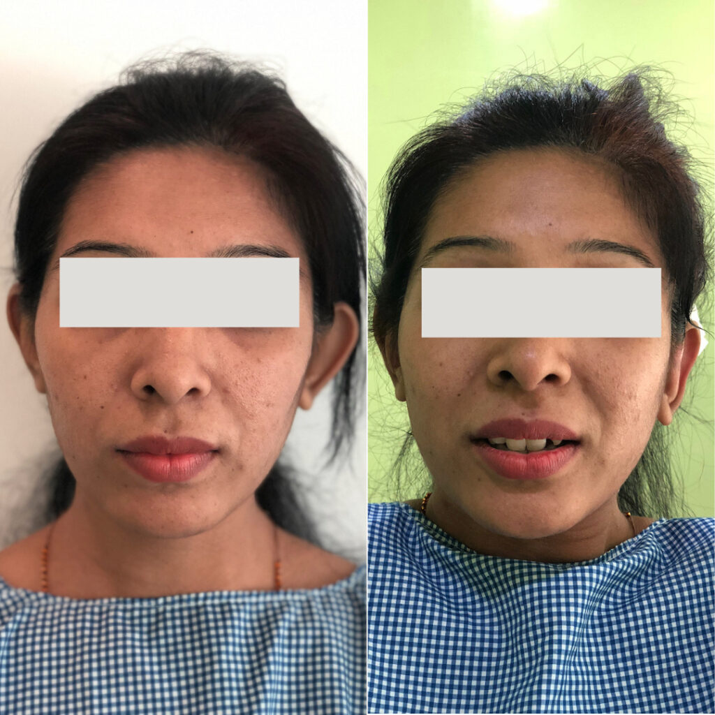 Otoplasty for Prominent Bat Ears Best Plastic Surgery, Dermatology