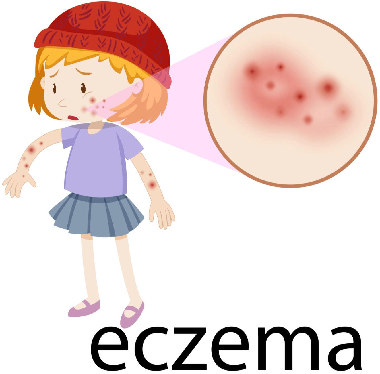 The 4 Main Reasons Eczema Flares Up in the Winter Convenient Urgent