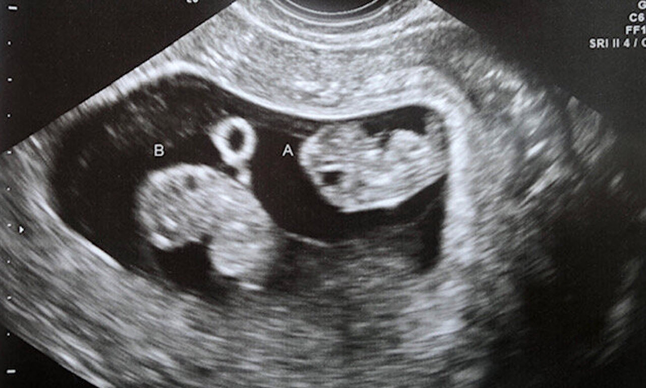 53YearOld Woman Gives Birth To Twins And SonInLaw Sees A Familiar