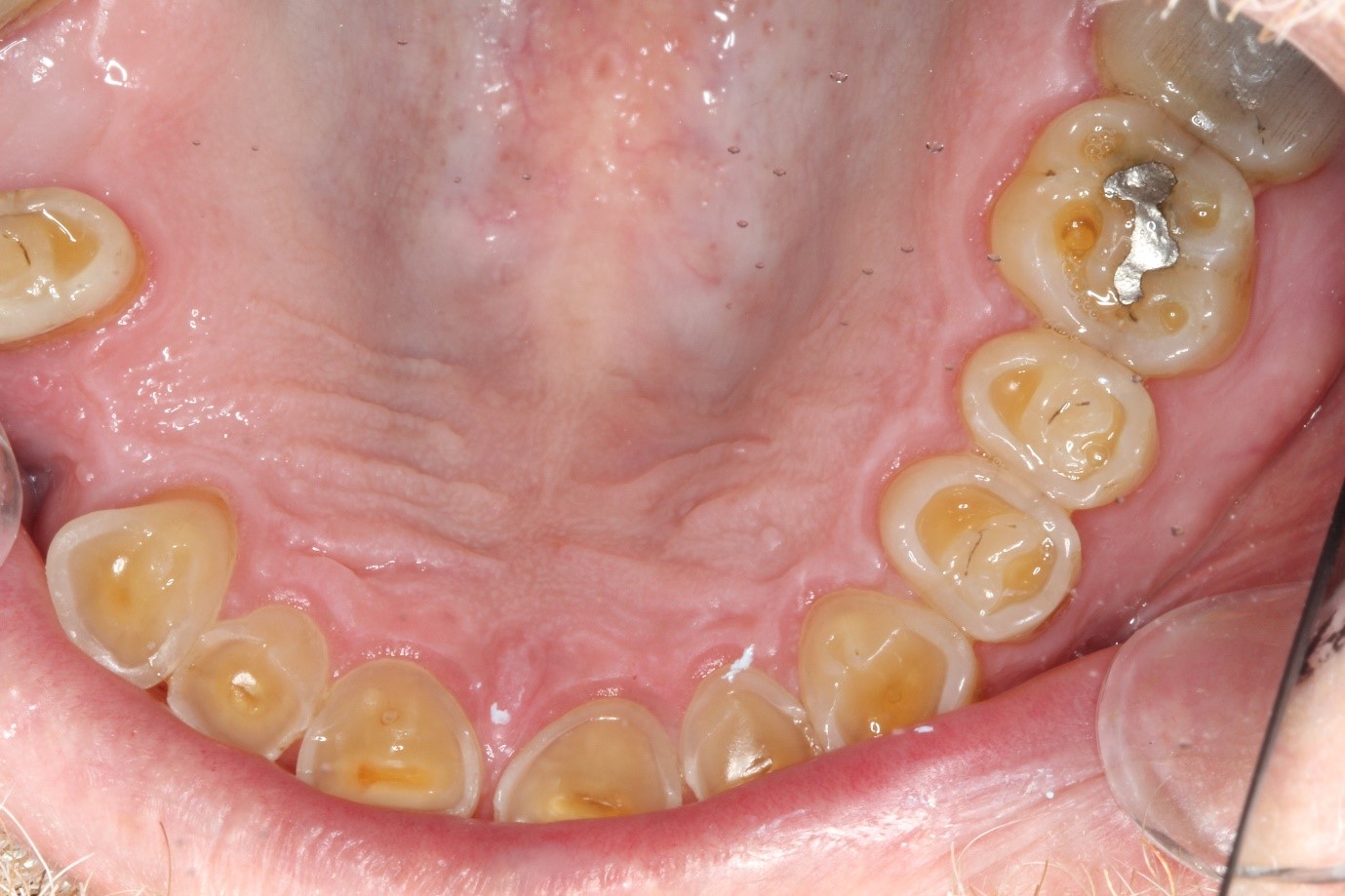 Affordable Smile Makeover Cooloola Cove Coloured Sands Clinic