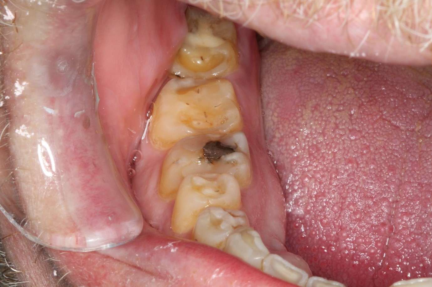 Dental Fillings Cooloola Cove Tooth Cavity Fillings Coloured Sands