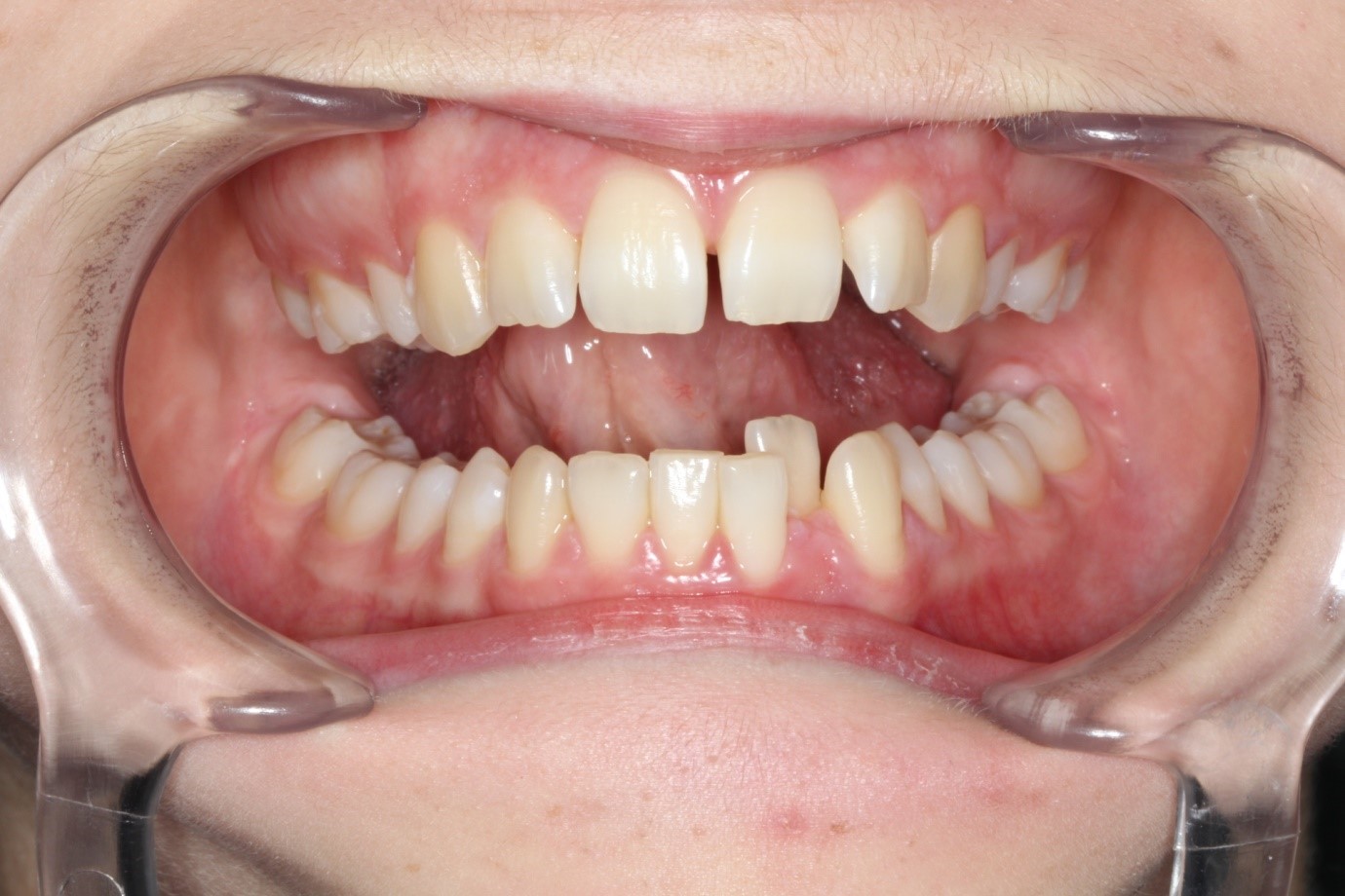 Clear Aligners Cooloola Cove Coloured Sands Clinic