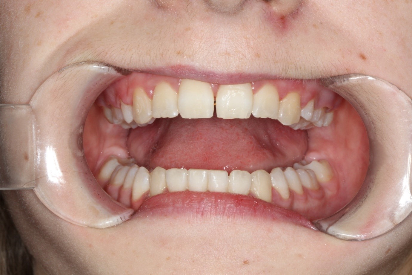 Clear Aligners Cooloola Cove Coloured Sands Clinic