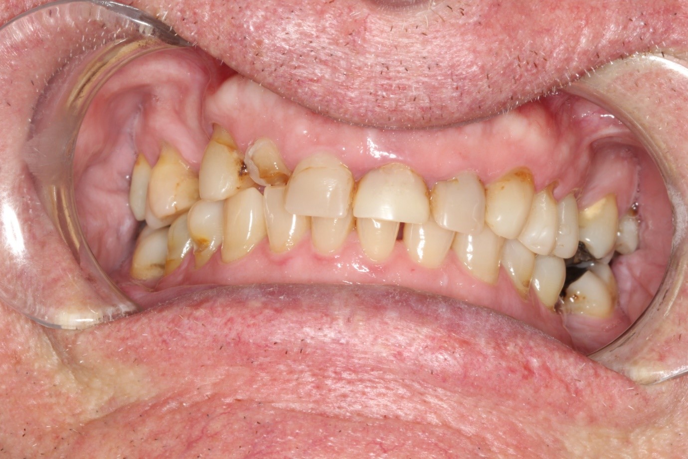 Same Day Dental Crowns & Bridges Cooloola Cove Coloured Sands Clinic