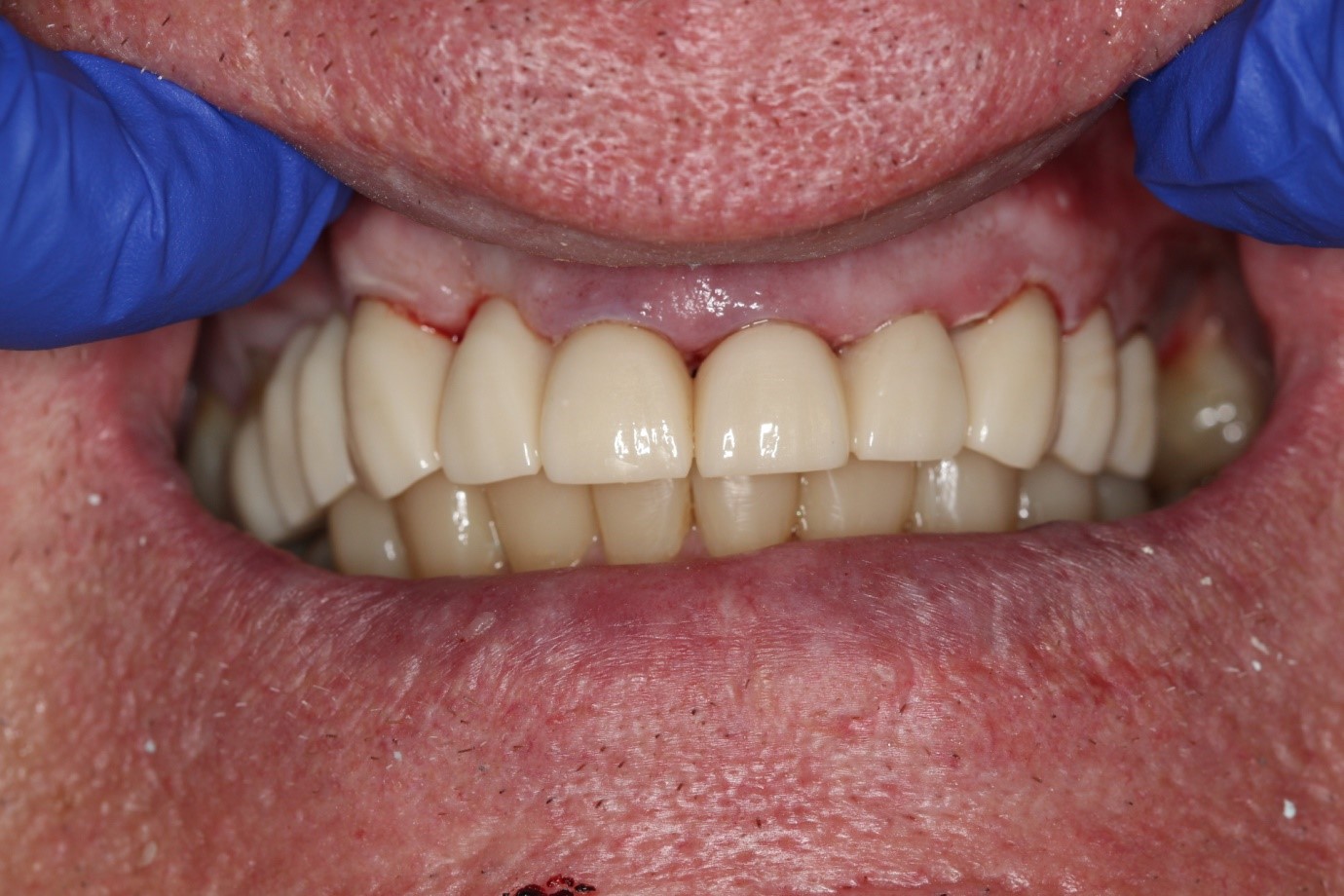 Same Day Dental Crowns & Bridges Cooloola Cove Coloured Sands Clinic