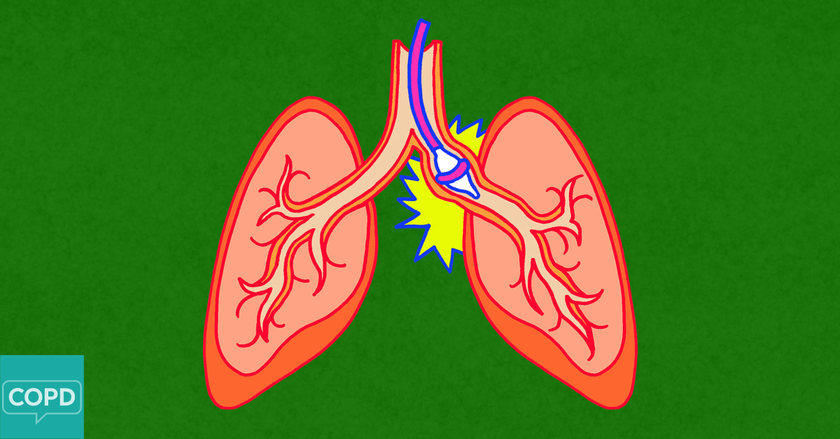 Targeted Lung Denervation for COPD Treatment