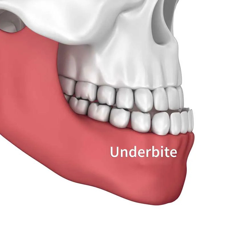 What is Underbite; Causes and Diagnosis Copperhills Dental Clinic