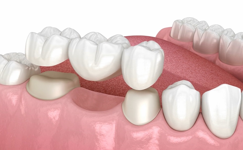 Affordable Dental Bridges in Camberley, Surrey Coppertop