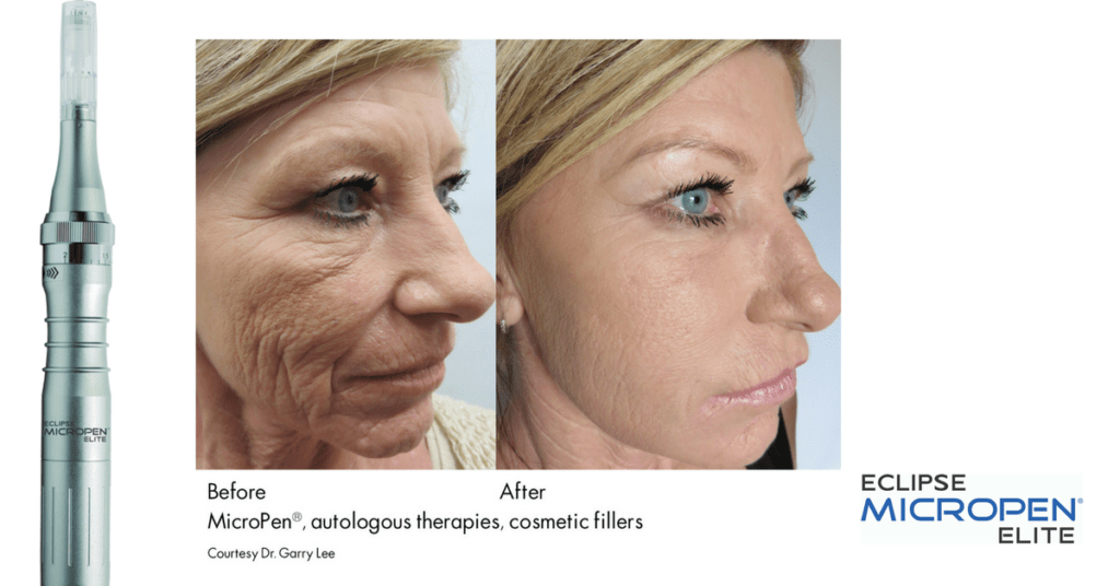 Medical Microneedling Coral Medical Health Spa