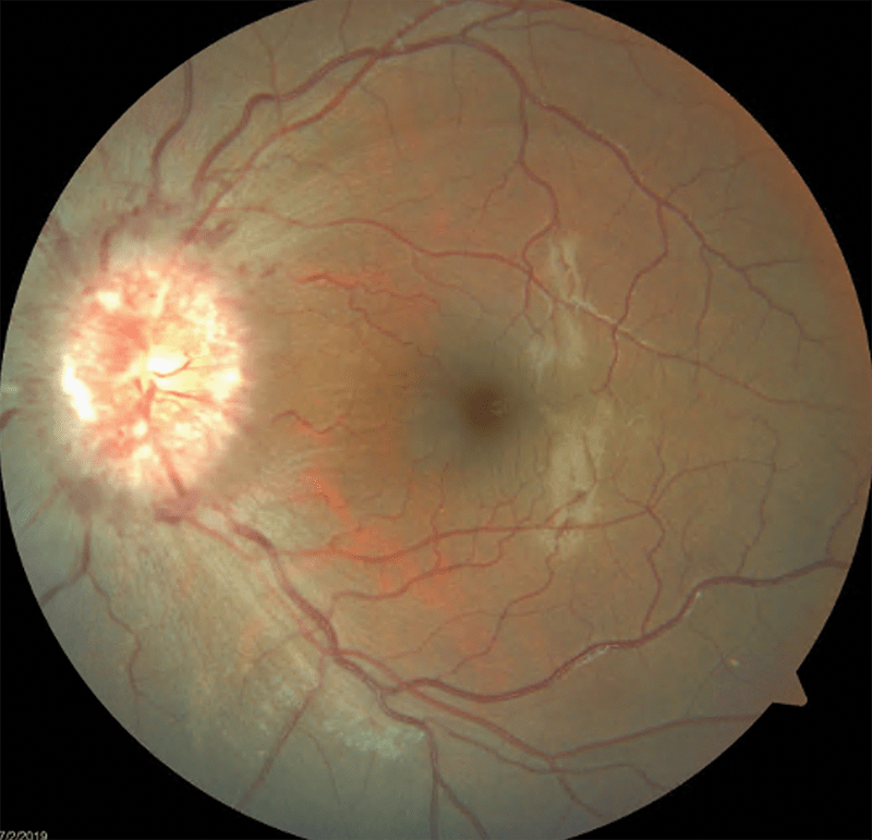 Idiopathic Intracranial Hypertension Modern Optometry