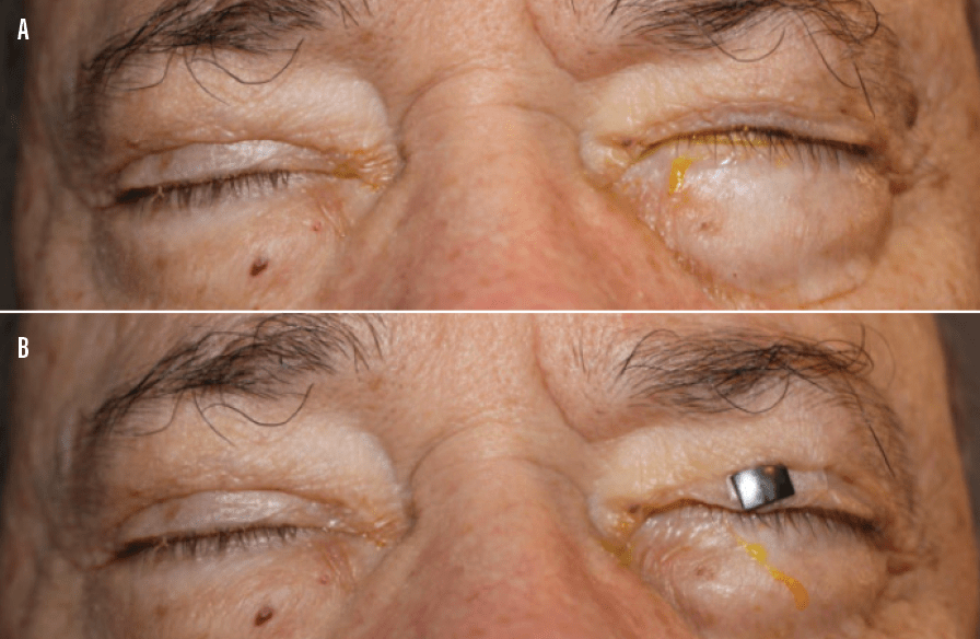 A Guide to Managing Blepharitis Modern Optometry