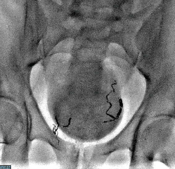 An Overview of Endovascular Treatment for Hemorrhoidal Bleeding
