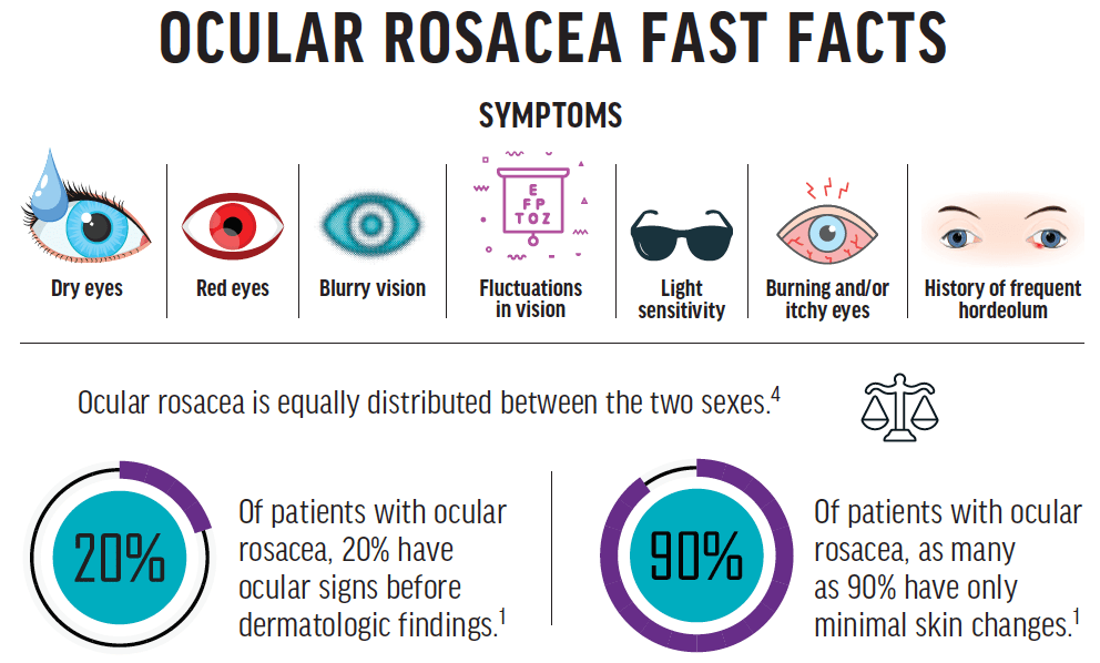 A Basic Guide to Ocular Rosacea Modern Optometry