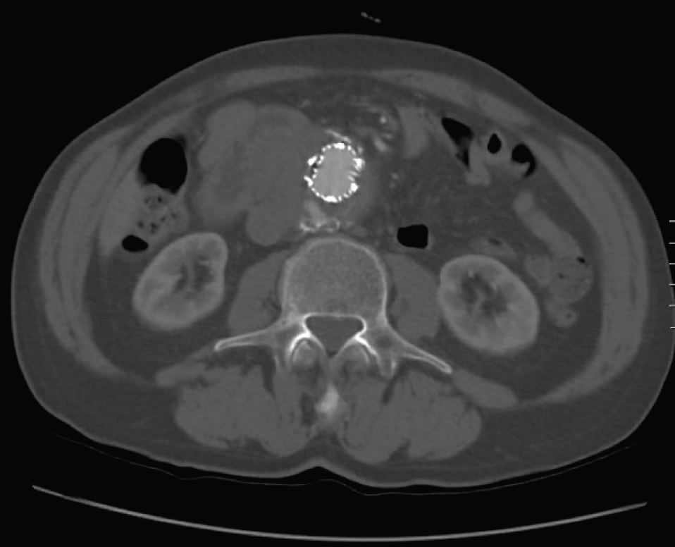 Coil Embolization of Type II Endoleak Endovascular Today