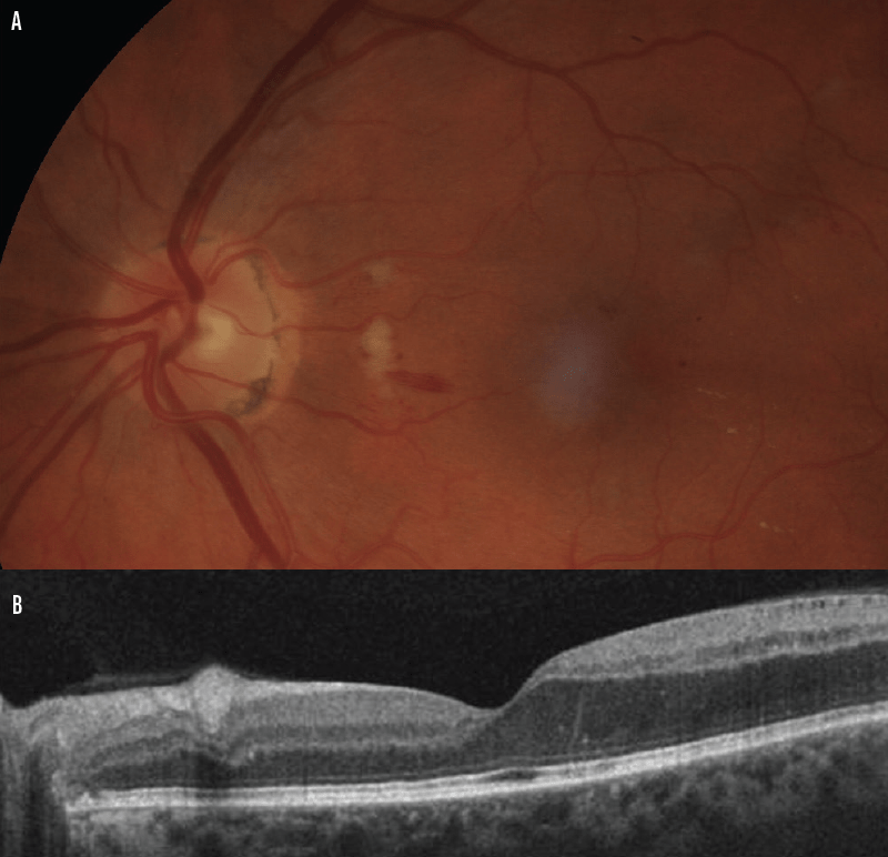 Cotton Wool Spot Oct