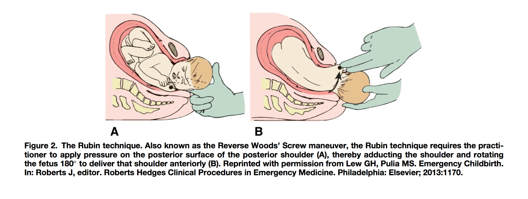 Shoulder Dystocia Core EM