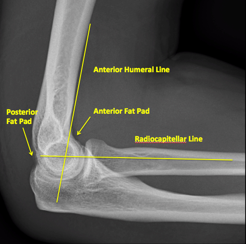Radial Head Fracture Core EM