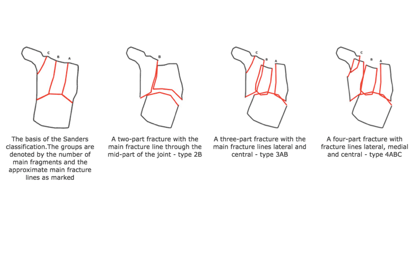 Calcaneus Fractures Core EM
