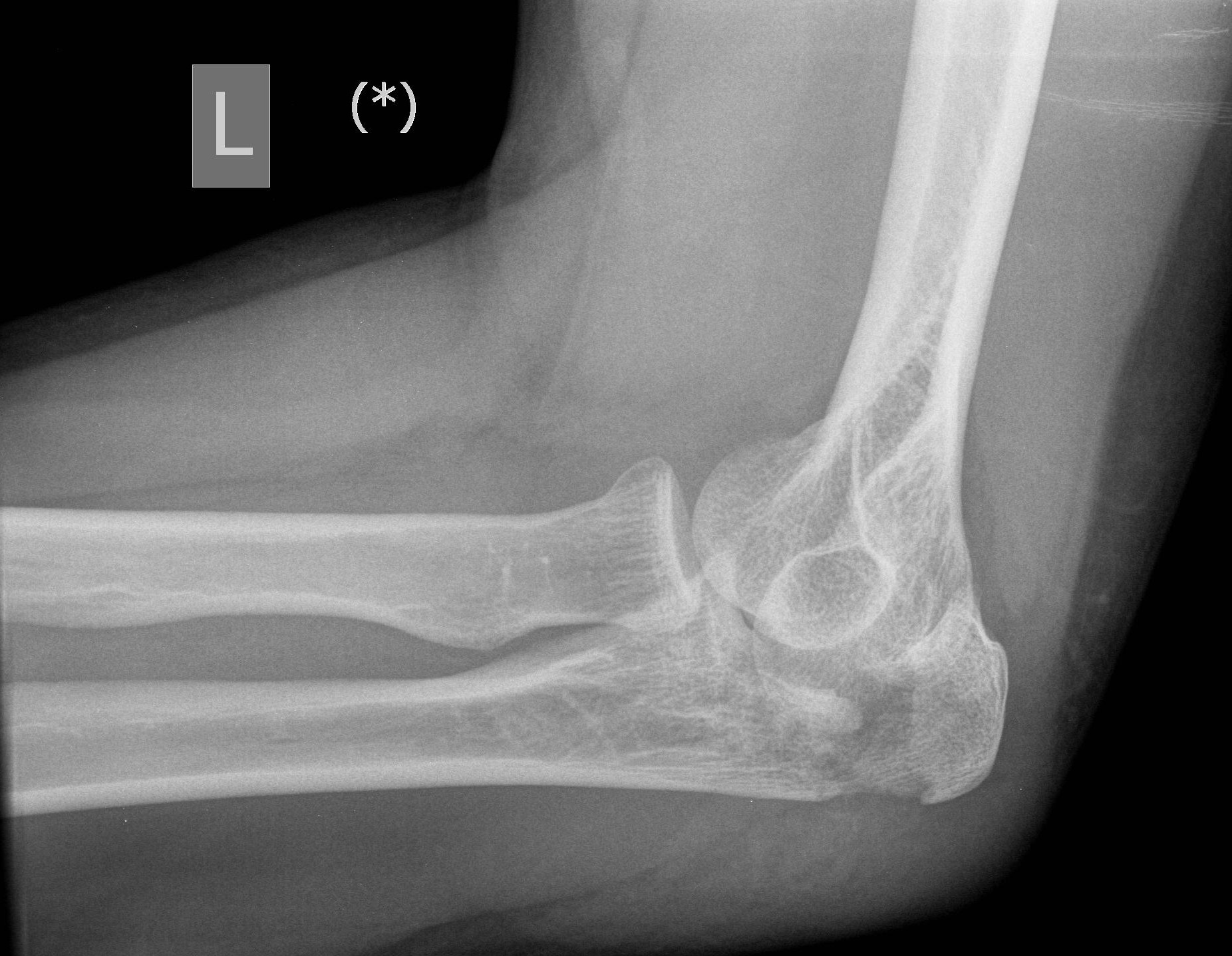 Olecranon Fractures Core EM
