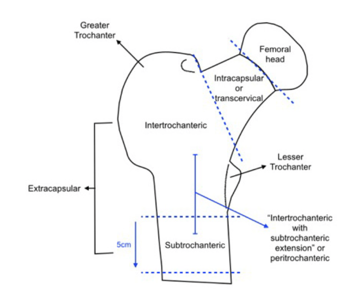 Femur Neck Fracture Classification