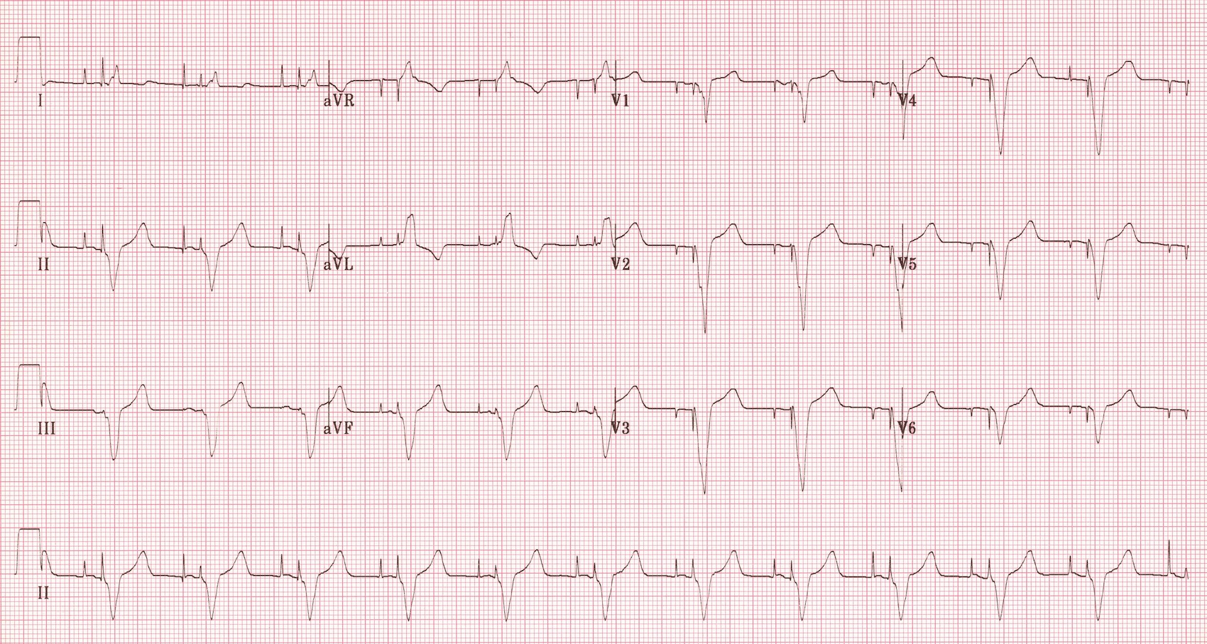 Pacemakers Basic Advanced Concepts Core Em