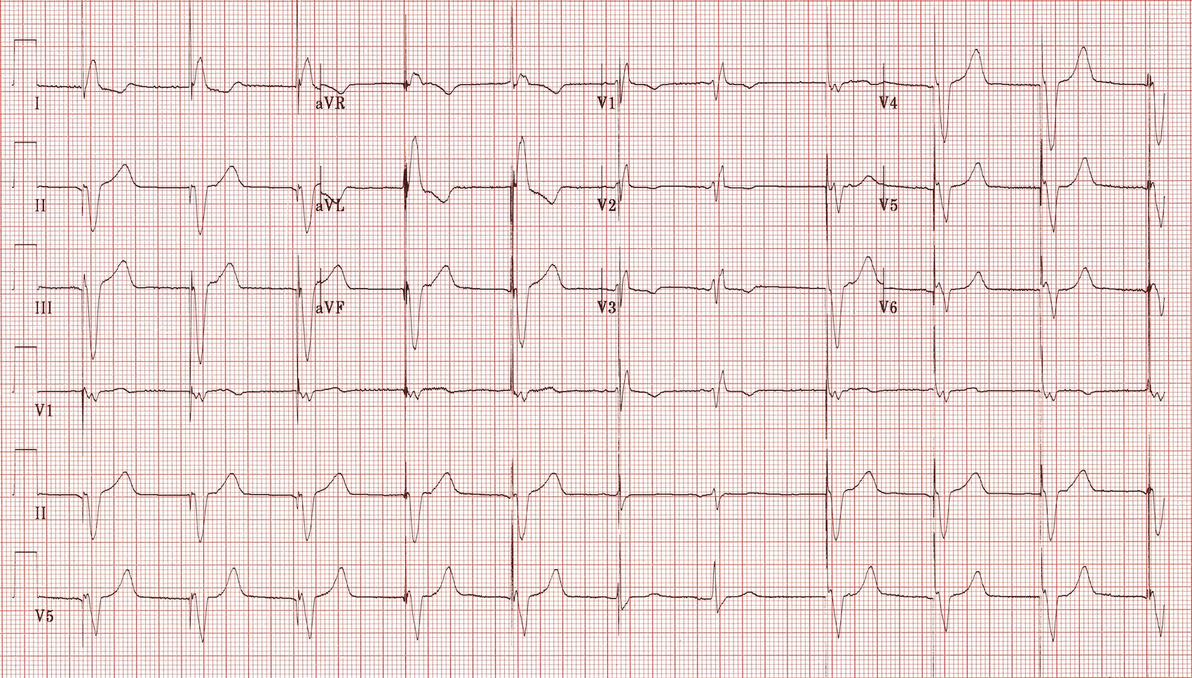 Pacemakers Basic Advanced Concepts Core Em