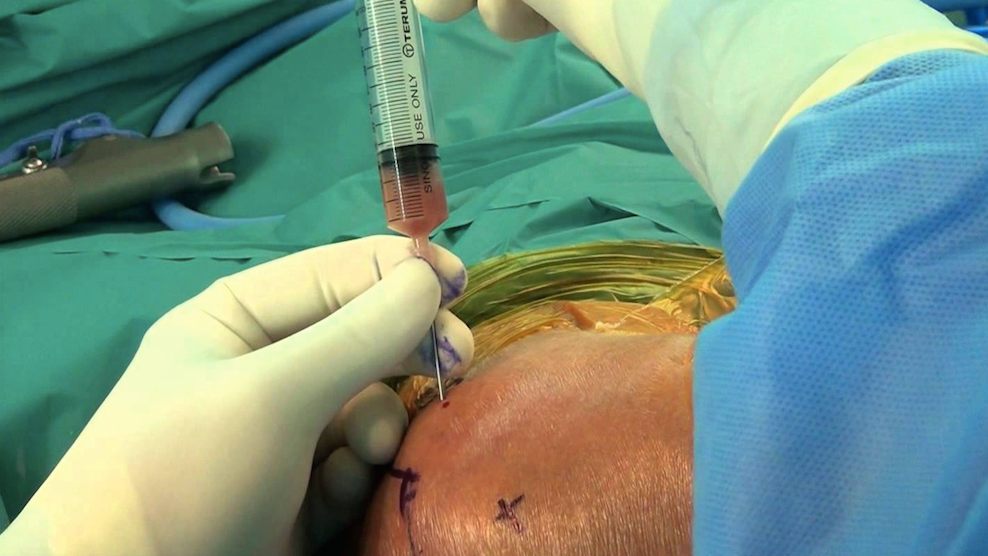 Septic Arthritis Core EM