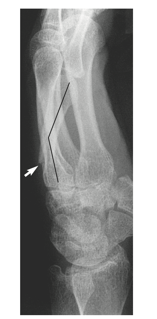 Metacarpal Fractures – Core EM