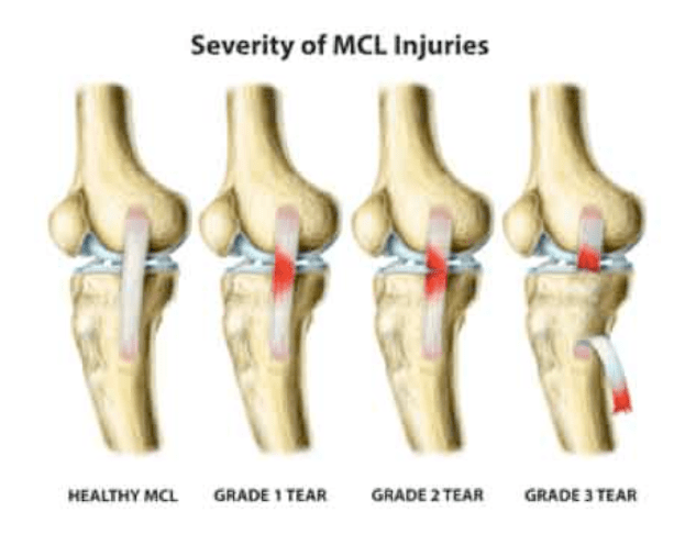Medial Collateral Ligament (MCL) Injuries Core EM