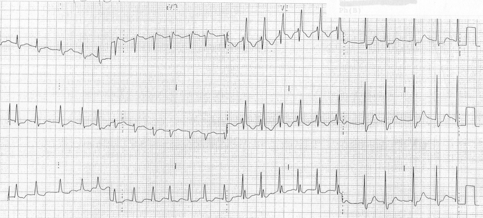 Bundle Branch Blocks Core EM