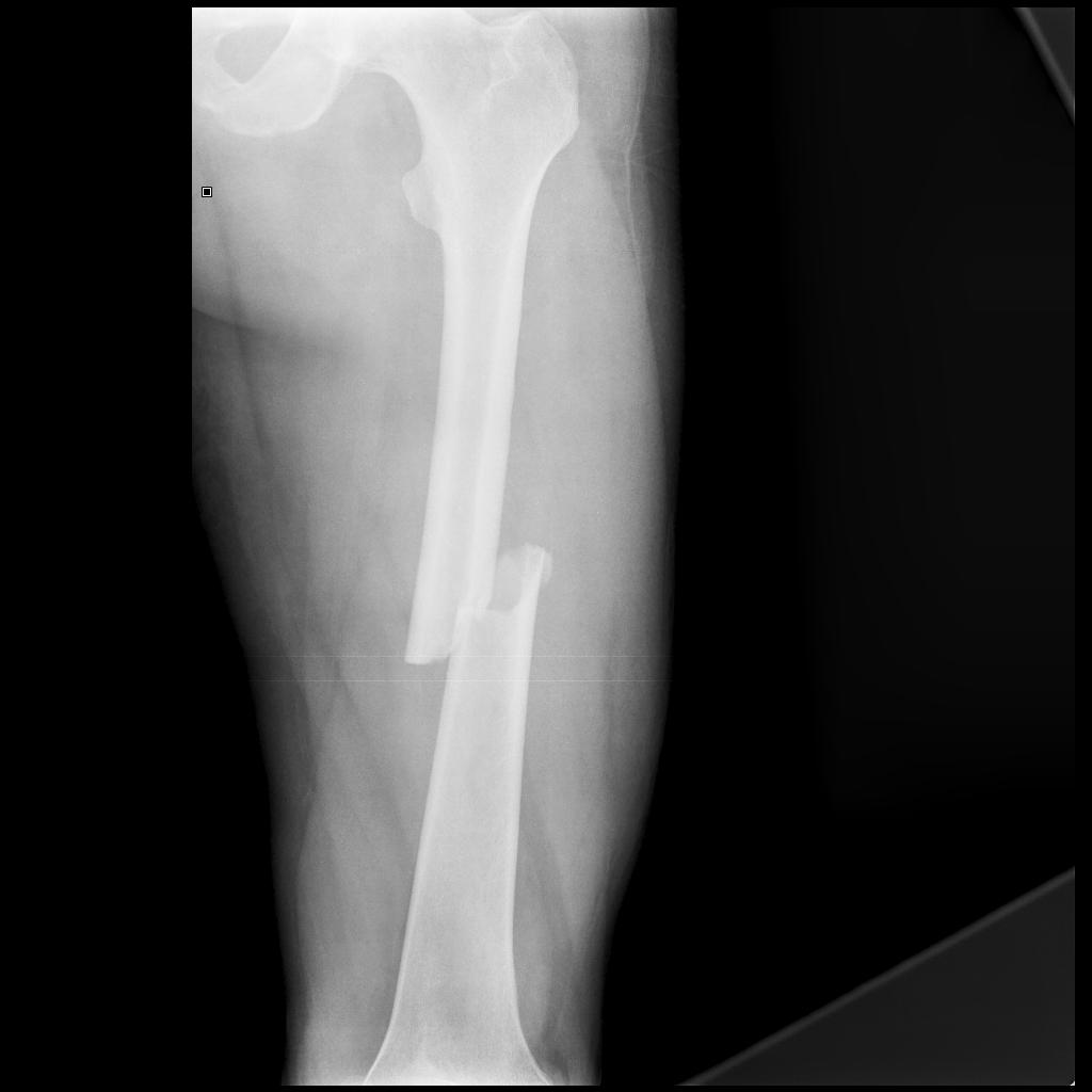 Femoral Shaft Fractures Core EM