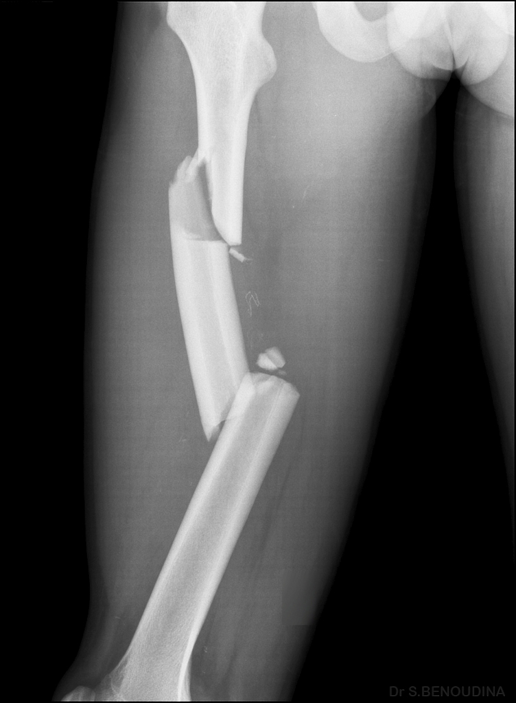 Femoral Shaft Fractures Core EM