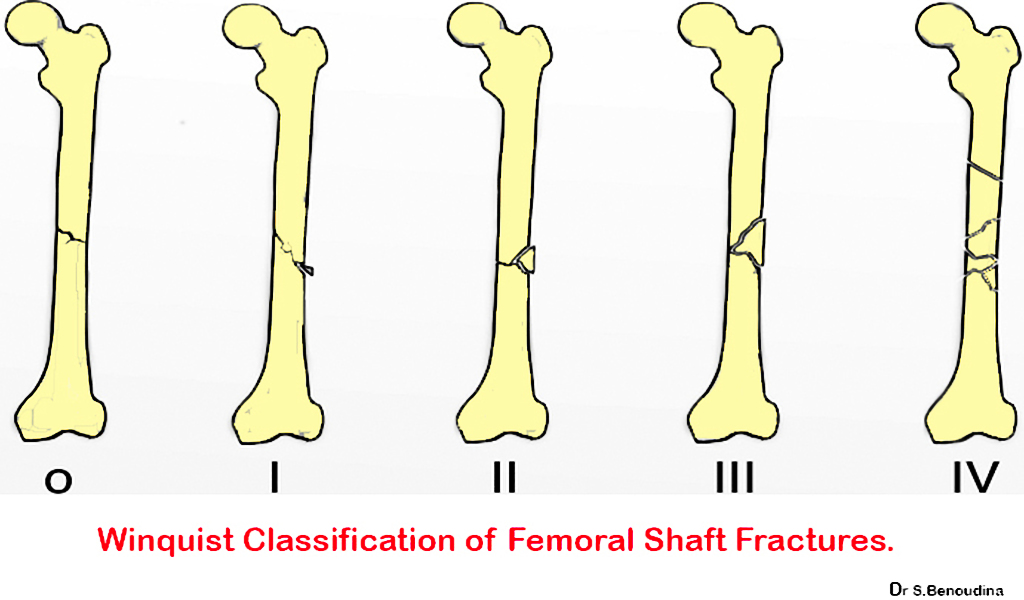 Femoral Shaft Fractures Core EM
