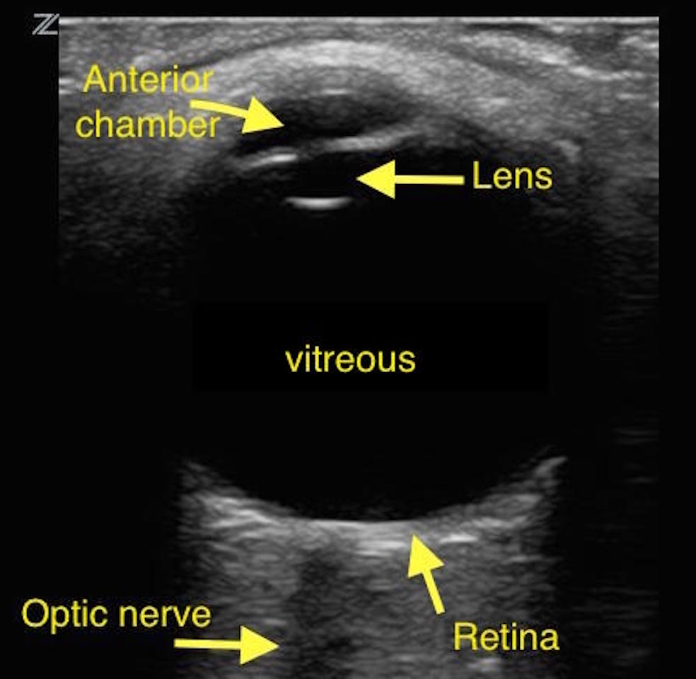 Ocular Ultrasound