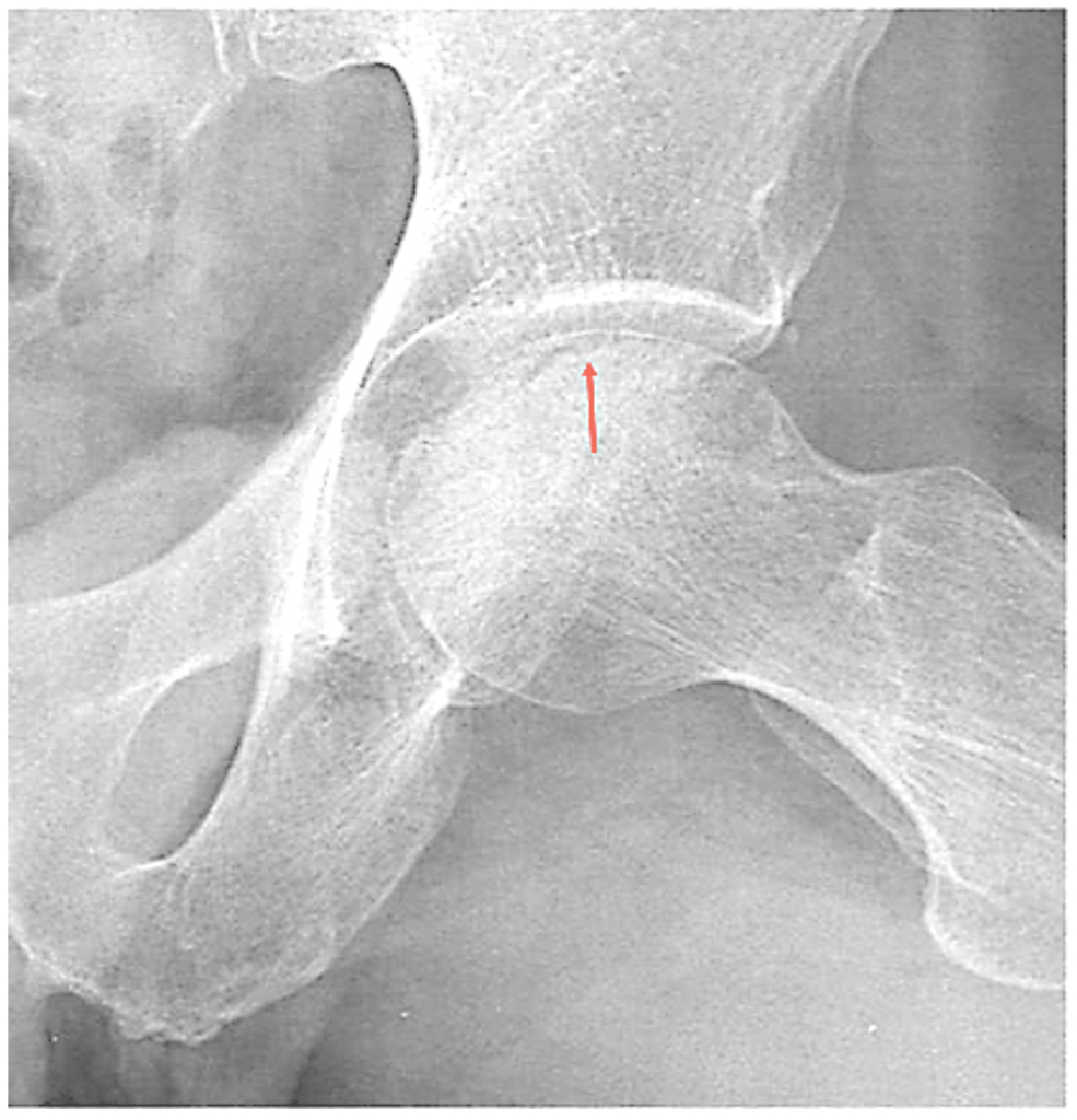 LeggCalvePerthes Disease Core EM