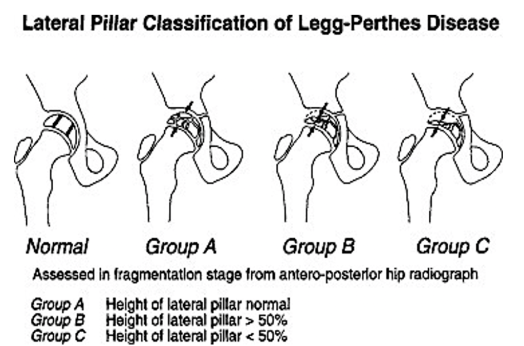 LeggCalvePerthes Disease Core EM