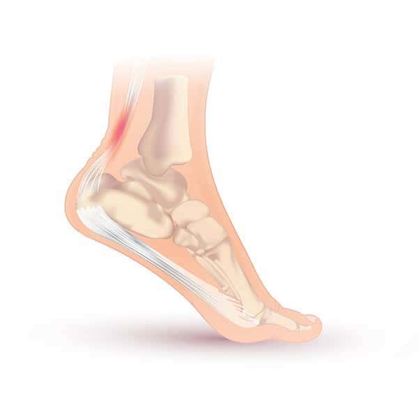 Achilles Tendonitis Physio Near Me Achilles Hell Sports Physio