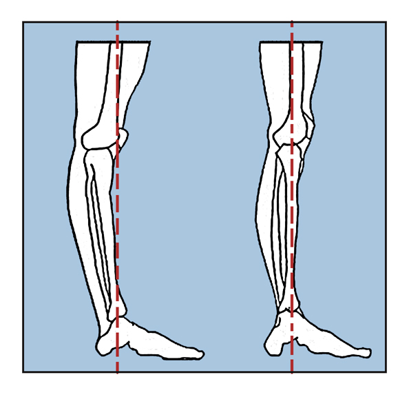 Hyperextension of the knee